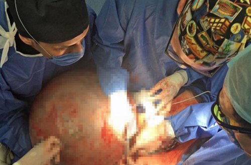 Qadının qarnından çıxanlar tibb dünyasını şoka saldı - FOTOLAR