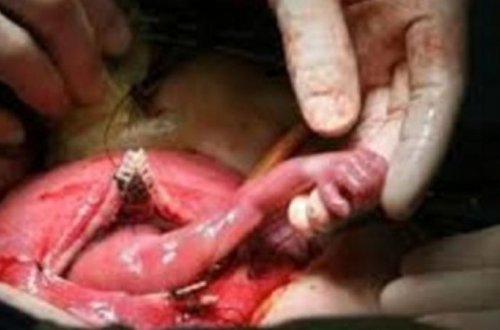 Ürəyi zəif olanlar baxmasın! - Abort olunan döl həkimin əlindən tutdu - DƏHŞƏTLİ VİDEO