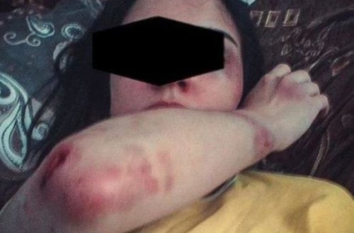 Azərbaycanda DƏHŞƏT: Ər hamilə arvadını ütü ilə yandırıb zorladı