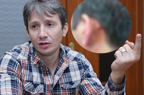 Azərin çəkilişdə qulağı cırıldı