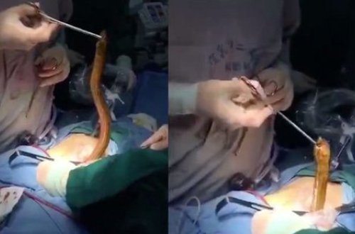 DÜNYA ŞOKDA! Mədəsindən İLAN ÇIXDI