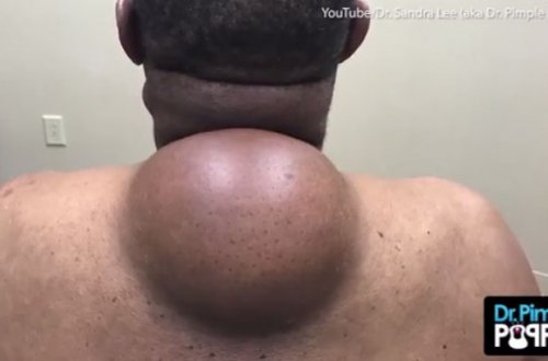 Əməliyyat zamanı şişin içindən görün nə çıxdı... - Çox baxmayın, ürəyiniz bulanacaq! / FOTOLAR