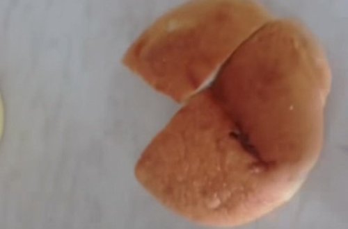 Vərəm dispanserində xəstələr görün nə ilə qidalanır-Nazirlikdən AÇIQLAMA