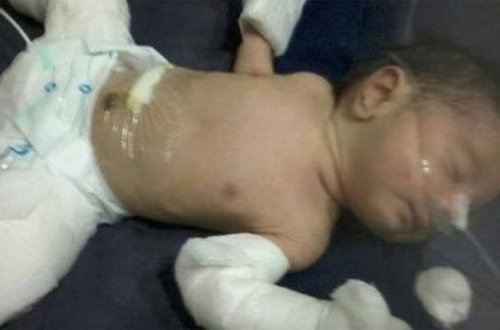 Ana bətnində uşaq əkiz tayını udub