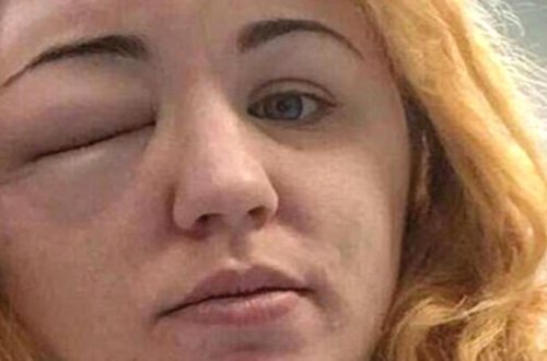 Saç rəngini dəyişmək istədi, başına gəlməyən qalmadı - FOTOLAR