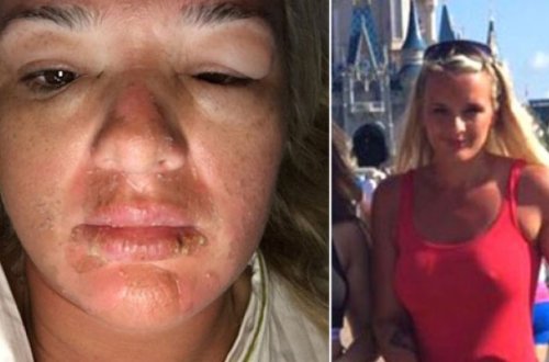 Sinəsinə silikon qoyduran qadın bu hala düşdü - FOTOLAR