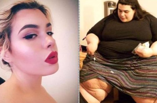 292 kiloqramlıq qadın arıqlayıb bu vəziyyətə düşdü - FOTOLAR