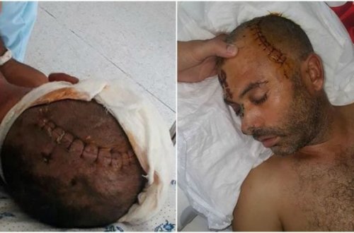 İzzət Bağırovun mühafizəçisinin döydüyü şəxsin vəziyyəti ağırdır