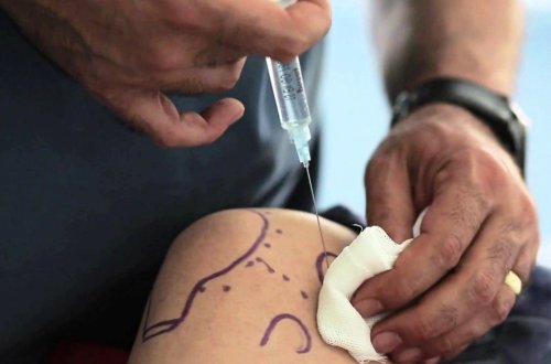 Bel ağrıları və disk yırtıqlarında əməliyyatsız üsul - BİR İYNƏ İLƏ MÜALİCƏ