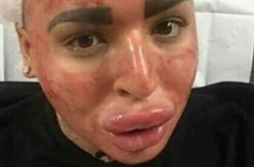 Bakıda estetik əməliyyat etdirən qız bu hala düşdü - FOTO