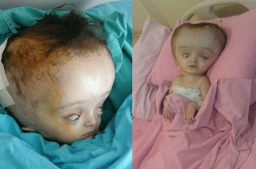 Azərbaycanda 3 yaşlı qız xəstəlikdən bu hala düşdü - FOTO