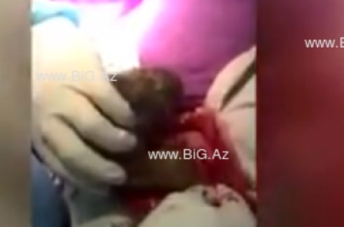 Bakıda xəstənin qarnından çıxanlar hər kəsi ŞOK ETDİ - VİDEO