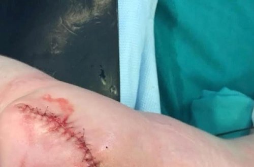 Uşaq 5 kiloqramlıq şişlə doğuldu - Azərbaycanda qəribə tibbi anomaliya/ FOTOLAR