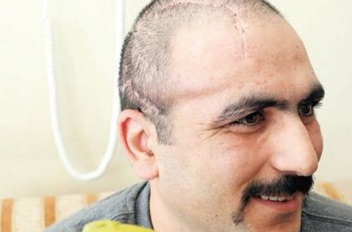 Aprel döyüşündə yaralanan hərbçiyə süni baş qapağı qoyuldu - FOTO