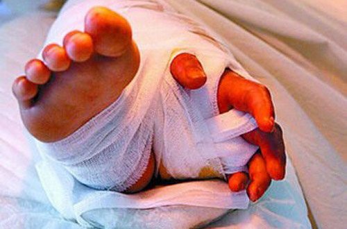 Fantastik əməliyyat! Uşağın kəsilmiş əlini görün harasına tikdilər - FOTO