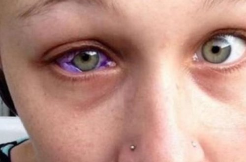 Gözünün rəngini dəyişmək istədi - Bəlaya düçar oldu - FOTOLAR