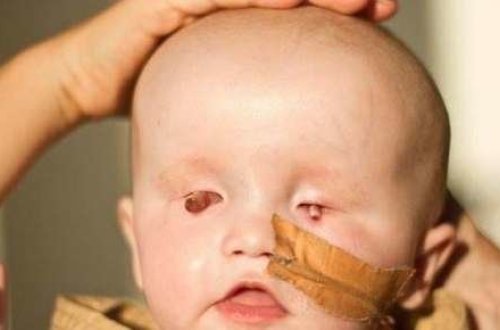 Uşaq gözsüz doğuldu - Görə bilməsi üçün həkimlər çarə axtarır