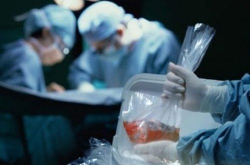 Azərbaycanda orqan transplantasiyası problemi