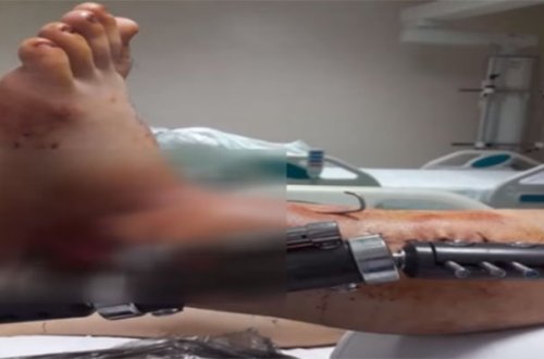 Bir həkim ayağını kəsdi, digəri yerinə tikdi - Video