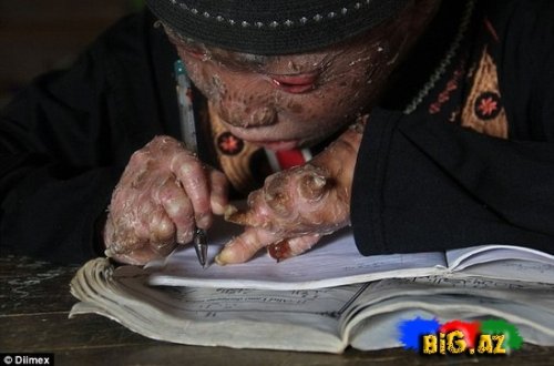 İnanılmaz xəstəlik: 41 gündən bir dərisini dəyişir - FOTO