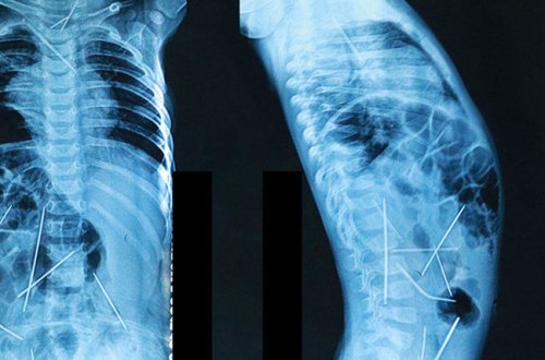 11 aylıq uşağın bədənində 16 iynə tapıldı - VİDEO