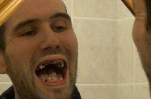 Hər gün qazlı su içən kişinin dişləri bu hala düşdü - FOTO