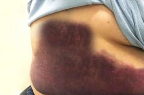 Qrip oldu, qabırğaları sındı - VİDEO