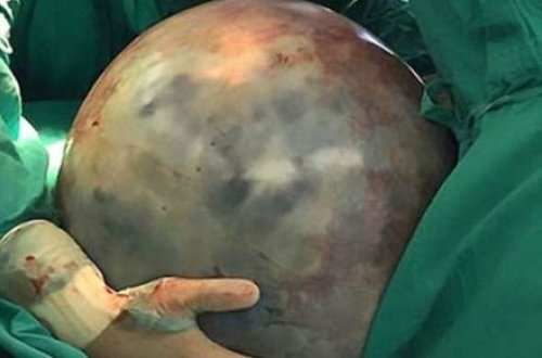 Yaşlı qadının qarnından çıxanlar həkimləri dəhşətə gətirdi - VİDEO