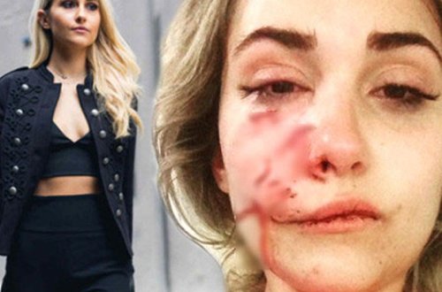 İt tanınmış modelin üzünü parçaladı - Üst dodağı tərpənmir - VİDEO - FOTO
