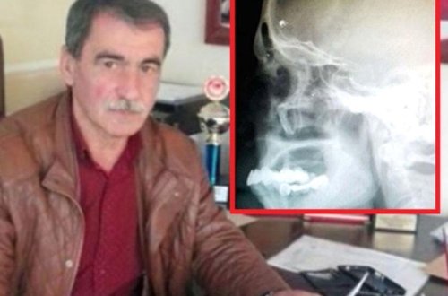 Başı ağrıyan kişini rentgenə saldılar: Həqiqəti görən həkim ŞOK OLDU - VİDEO