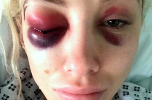 Əsir götürülüb zorlanan modelin bir gözü kor oldu (+18 FOTO)