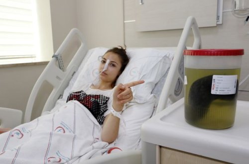 Türkiyəli gəncin mədəsindən çıxanlar həkimləri şoka saldı – FOTO