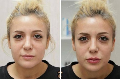 Səidə dodaqlarını böyütdürdü