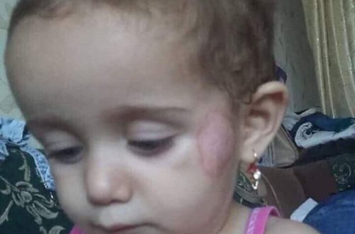 Bağçada körpənin xəsarət almasına görə iki nəfər işdən çıxarılıb