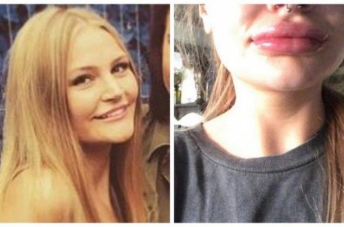 Vurdurduğu iynəyə görə dodaqları eybəcər hala düşdü, həkimlərin cavabı isə şok etdi - Video