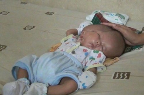 İndoneziyada iki üzlü körpə doğulub - FOTO/VİDEO