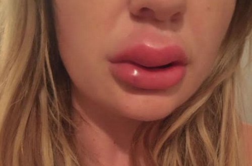 Dodağını şişirdən qadın: 