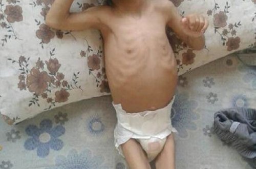 Ac qaldığına görə it-pişik əti yedi, infeksiyaya yoluxdu - Ürəkparçalayan FOTO