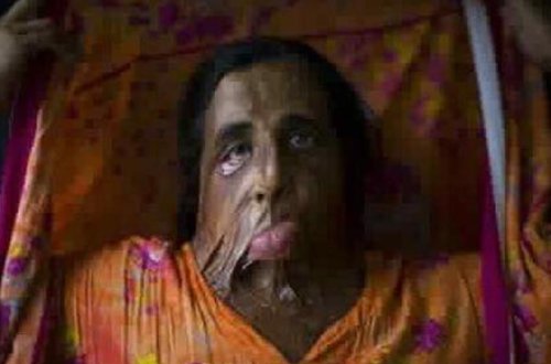 Ərinin cinsi istəyinə yox dedi, üzünü kislota ilə yandırdılar