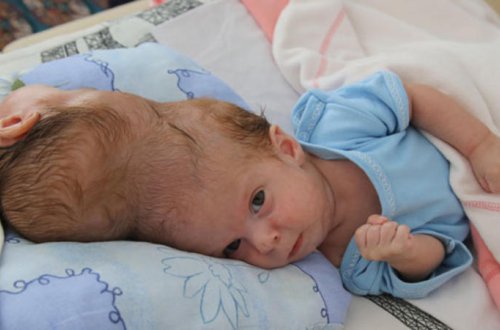 Siyam əkizlər ayrılmaq üçün saatları sayırlar