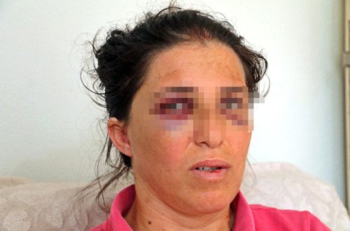 Qadın əri tərəfindən bu hala salındı – ŞOK SƏBƏB - FOTO