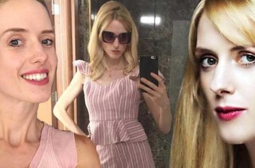 Anoreksiya xəstəsi olduğu deyilən aktrisadan bikinili poz - Fotolar