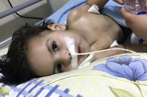 Bütöv fındıq udan uşaq infarkt keçirdi: nə danışa bilir, nə gəzə - FOTO