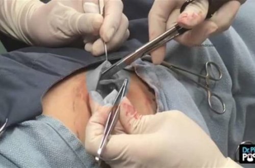 Ombasındakı şişə görə həkimə getdi - Çıxanlara İNANMADILAR - FOTOLAR