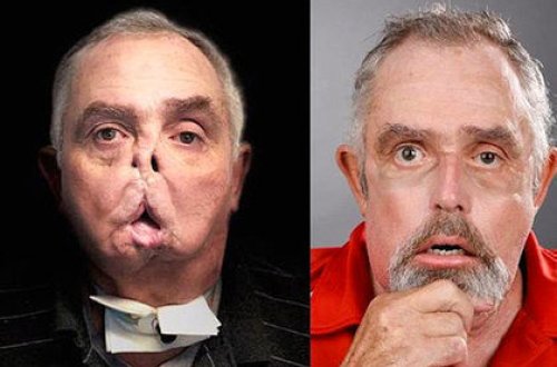 Yaşlı ovçuya yeni üz nəqli baş tutdu