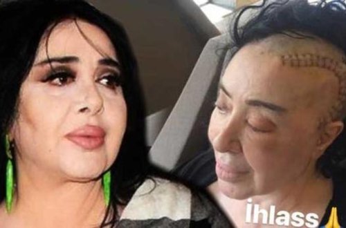 Beyin əməliyyatı keçirən məşhur modelyer tikiş izini paylaşdı - FOTO