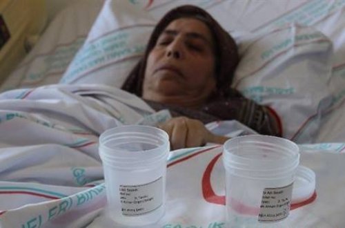 66 il öncə udmuşdu- Həkimlər görəndə heyrətə düşdü - FOTO