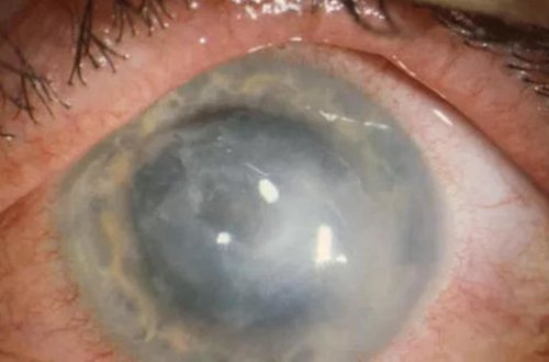 Linza istifadəçilərinə XƏBƏRDARLIQ - TƏHLÜKƏLİ İNFEKSİYA