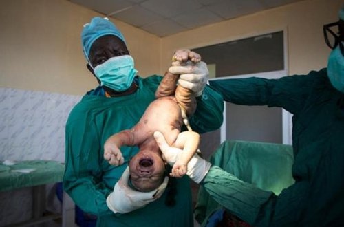 Bu ölkədə xəstələri maşın ehtiyat hissələri ilə əməliyyat edirlər - FOTO