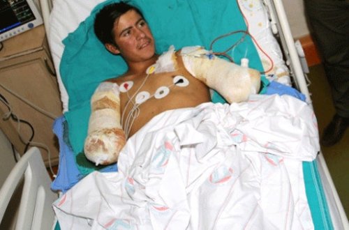 17 yaşlı gənc quşu xilas etmək istəyərkən qollarından oldu - FOTO